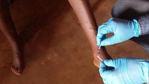 Kasus Varian Baru Mpox Meningkat di Uganda, Bisa Menyebar dari Kulit ke Kulit