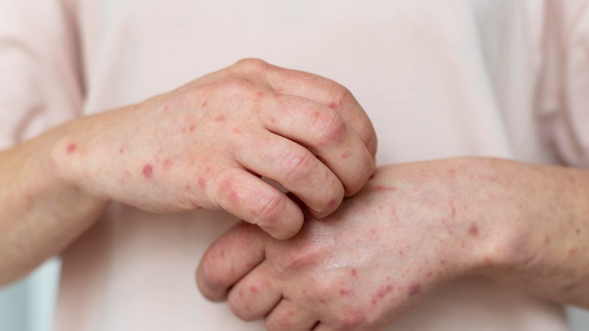 How Long Will Waterpox Be Healed In Children And Adults? Affected By Several Factors