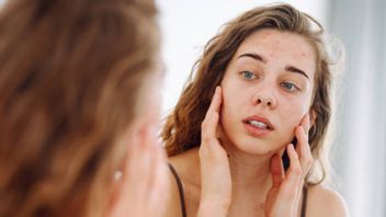 Kulit Berjerawat Dianjurkan Pakai Skincare Berbasis Air, Ini Alasannya