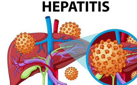 Gejala Hepatitis Misterius dan Penyebabnya yang Membingungkan para Peneliti