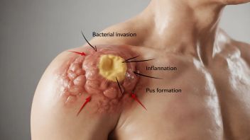 Manjur Banget! This is How to Treat Boils to Make Them Quickly Flat