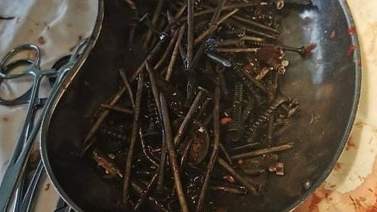 Three Hours Of Operation, Doctor Successfully Removed 1 Kilogram Of Nails, Nuts And Bolts From Patient's Stomach