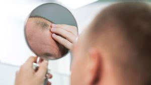 Kenali Pola Kerontokan Rambut Akibat Hormon: Apa Itu Alopecia Androgenetik?