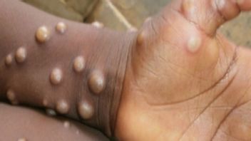 Overcoming The Monkeypox Outbreak, These Are Some IDI Recommendations