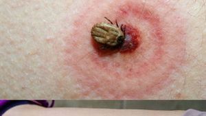 Penyebab Penyakit Lyme dan Gejalanya