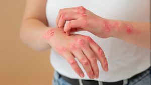 Get To Know The Symptoms Of Smallpox In The Elderly As An Early Prevention Step