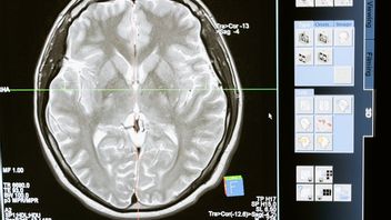 En Apprenant De L’incident De Tukul Arwana, Voici Comment éviter Les Saignements Dans Le Cerveau