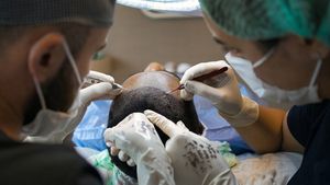 Apa Efek dari Transplantasi Rambut? Simak Dampak Negatifnya di Sini