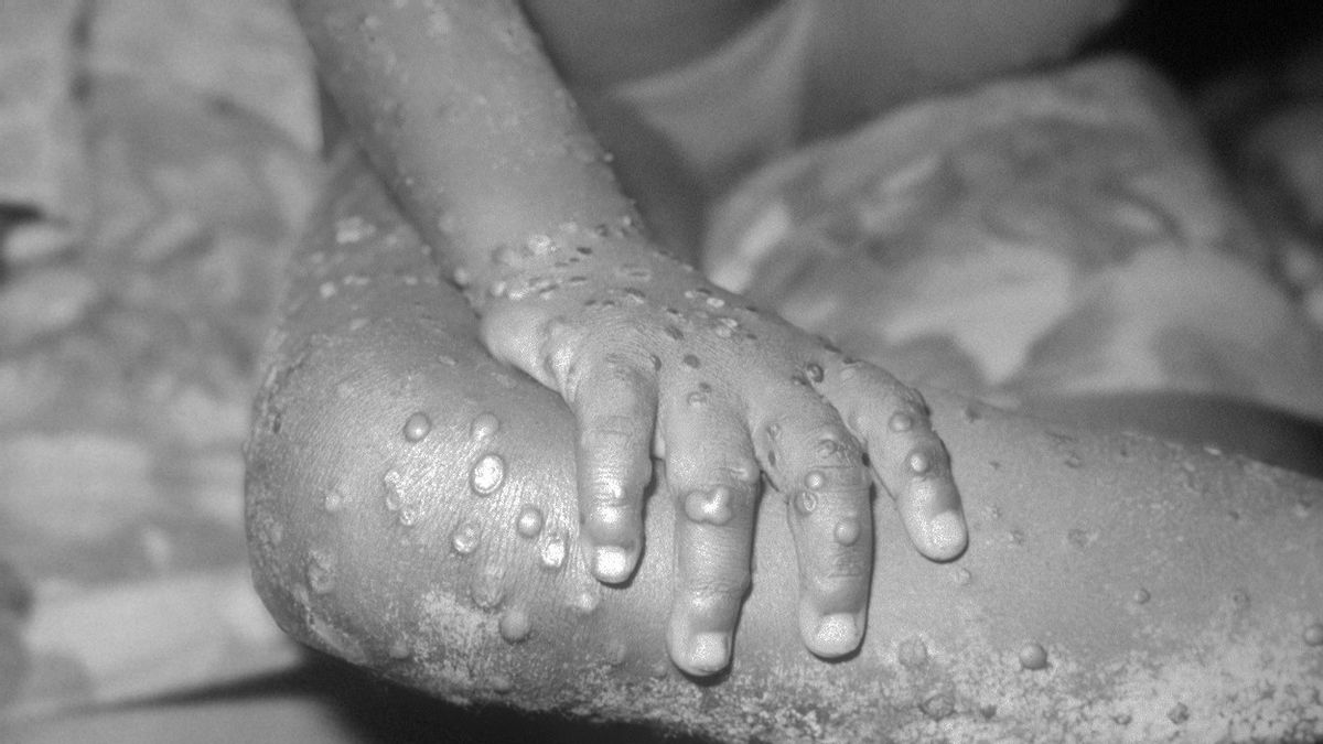 European Sanctions On Ukraine, Russia Asked For Help And Consultations In Combating The Monkeypox Outbreak