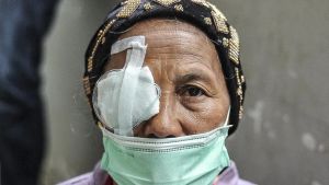 10 Penyebab Katarak yang Wajib Diketahui, Apa Saja?