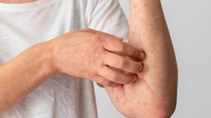 Jangan Salah Identifikasi, Ini Perbedaan Campak dan Rubella yang Memiliki Gejala Serupa 