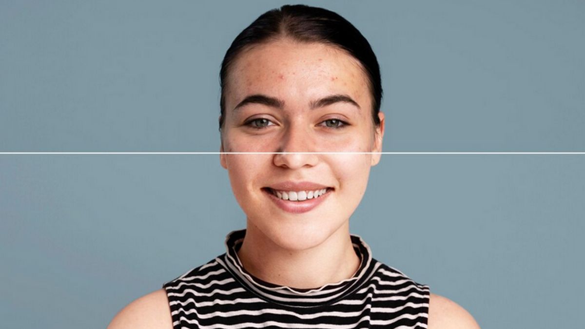 7 Kandungan Skincare untuk Menghilangkan Bekas Jerawat, Ampuh Bikin Kulit Cerah Lagi