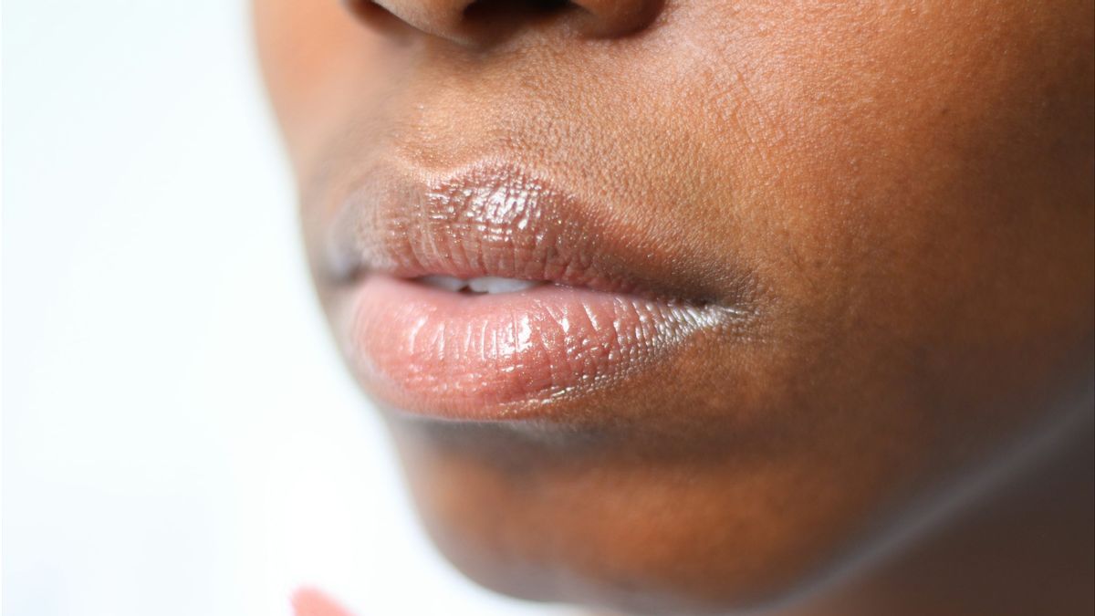 Penyebab Jerawat di Bibir dan Obatnya
