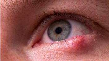 Unclean Remove Makeup Can Cause Hordeolum, Small GROUP In The Eye