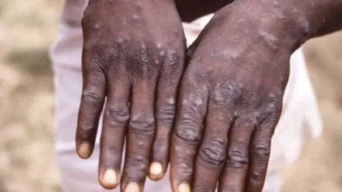 Plus clair sur la peste Monkey Pox, la compréhension, les symptômes et comment surmonter