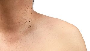 Beberapa Fakta Skin Tag yang Umumnya Muncul di Kulit Leher
