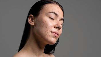 顔の皮膚に斑点を与えるのと同じように、これらはメラスマと黒い斑点の4つの違いです