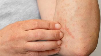 Dry Eczema In Hand: Cause And How To Overcome It
