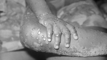 感染の44症例を記録、オーストラリアは国家的意義としてサル痘を割り当てます