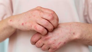 Campak Tidak Sama dengan Rubella, Kenali Perbedaannya agar Tak Salah Penanganan