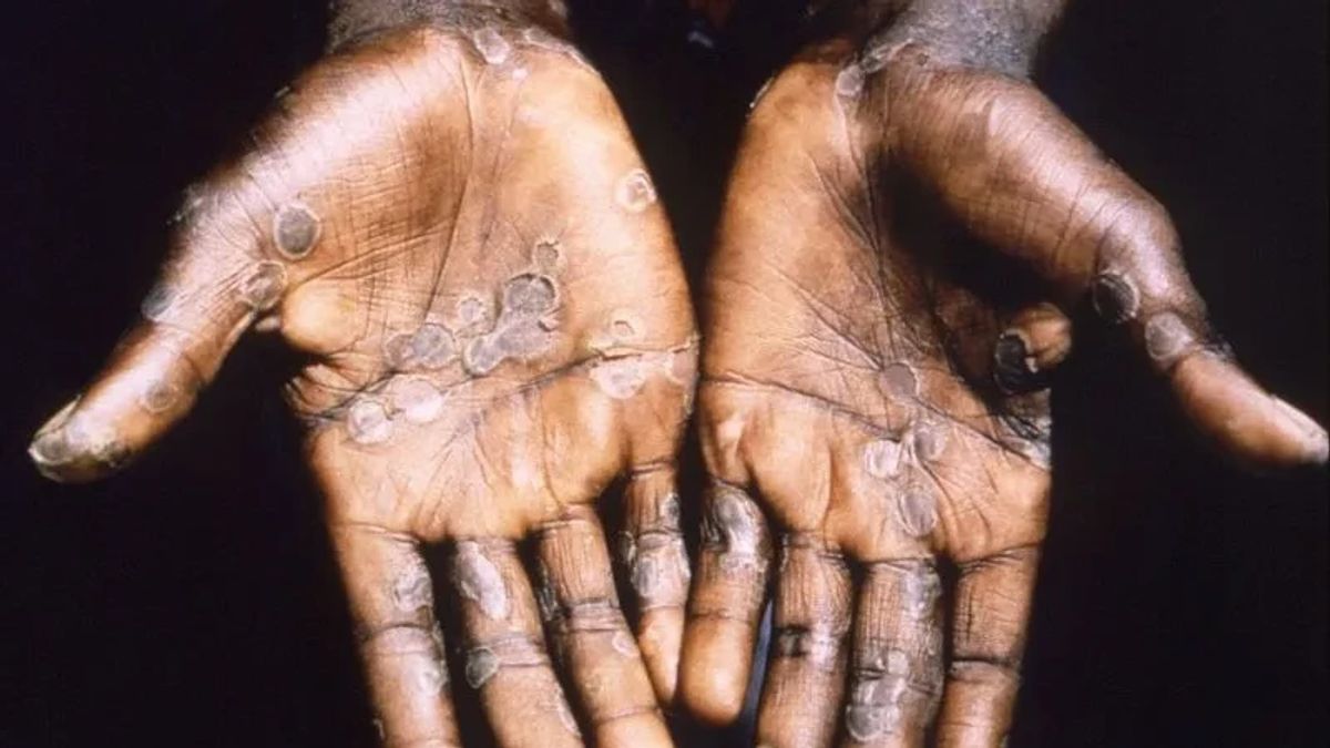 6 Monkeypox Cases In Jakarta Detected In The Last 9 Days