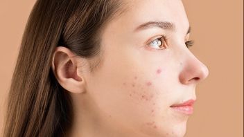 6 Sleep Pattern Errors That Can Cause Your Face To Acne