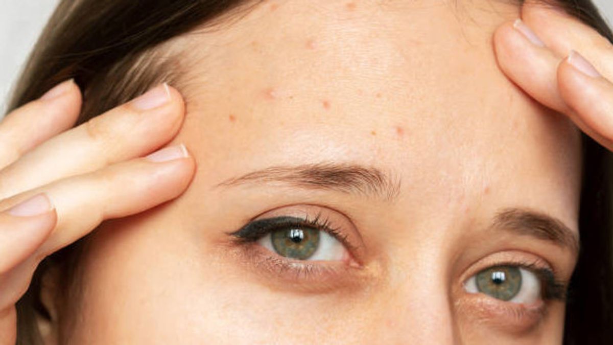 デング熱にきびを和らげるのに役立つ5つのライフスタイルの変化