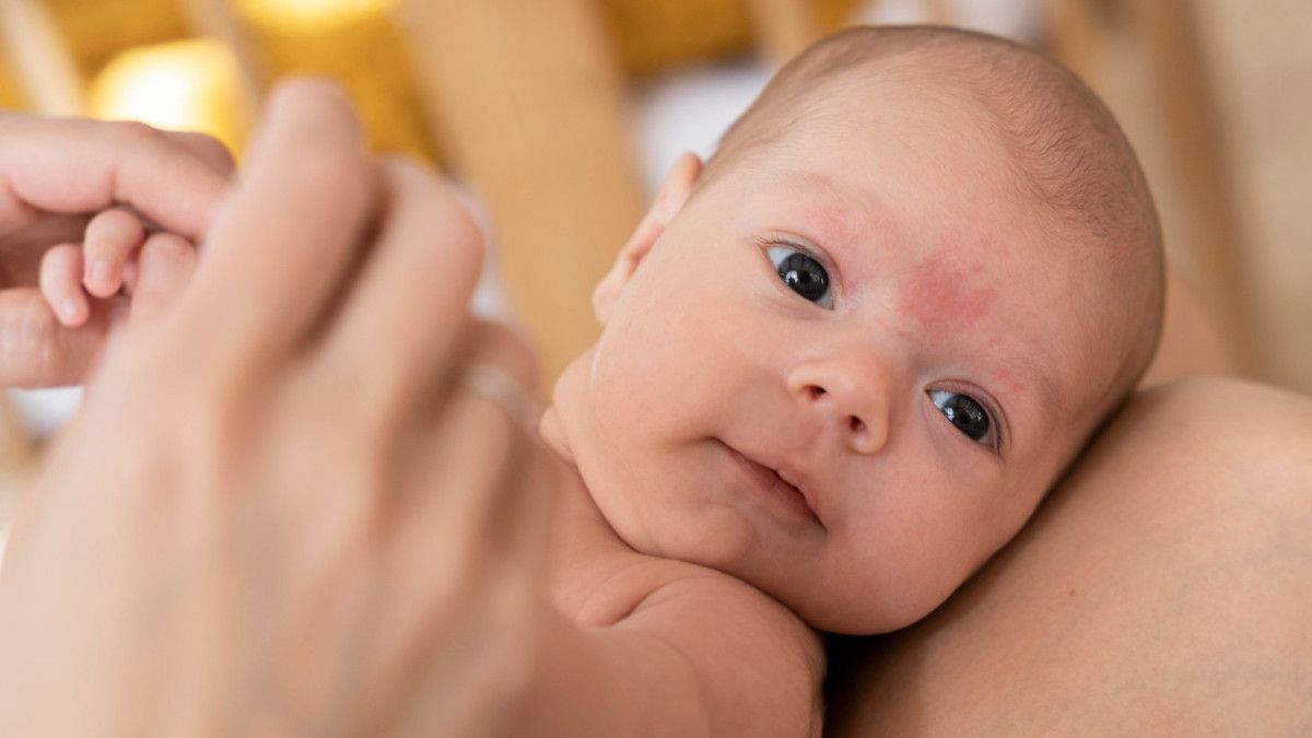 Mengenal Penyebab Jerawat dan Bintik Merah pada Bayi, Begini Cara Mengobatinya
