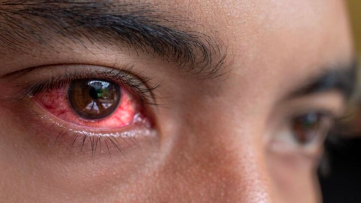 cottes provoquent-elles vraiment des yeux rouges? Voici l'explication