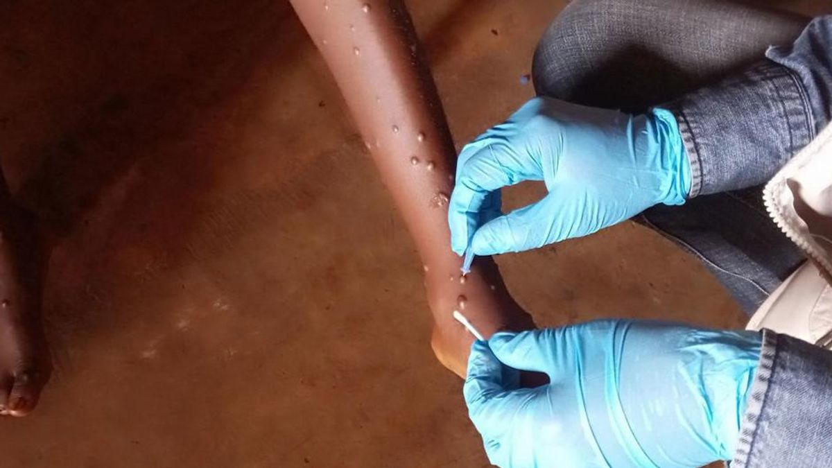 DIY Health Office Beware Of Post-Dispute Monkeypox Found 2 Alleged Cases