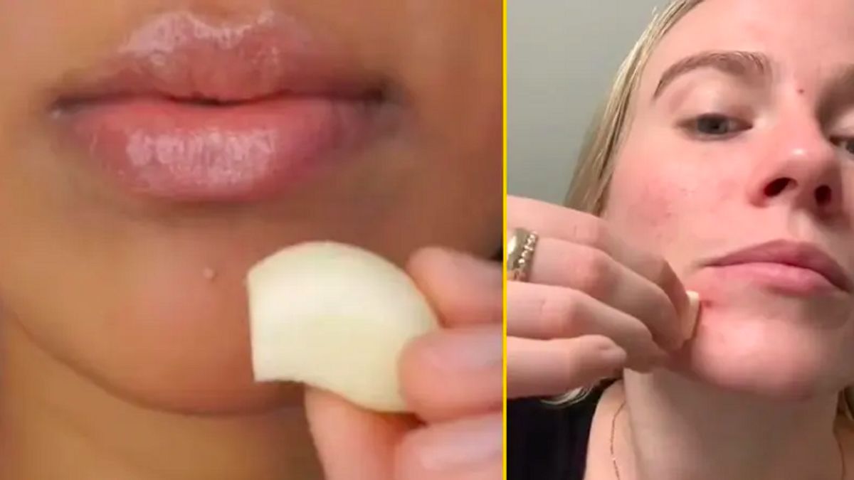 Is It True That Garlic Is Effectively Used To Overcome Acne?