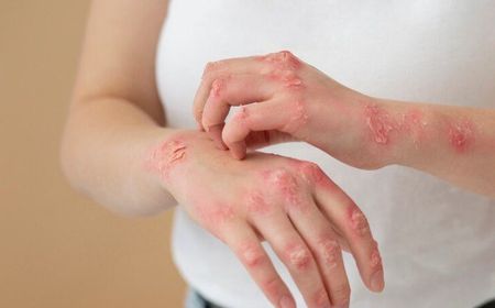 7 Pantangan Makanan untuk Penderita Impetigo agar Tidak Bertambah Parah