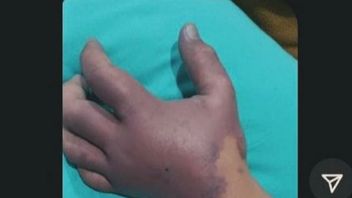 4 Jari Diamputasi, Korban Dugaan Malapraktik di RS Islam Pondok Kopi Sudah Rawat Jalan