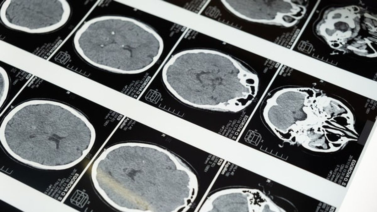 Apa Penyebab Pendarahan Otak? Penyakit yang Diderita Tukul Arwana