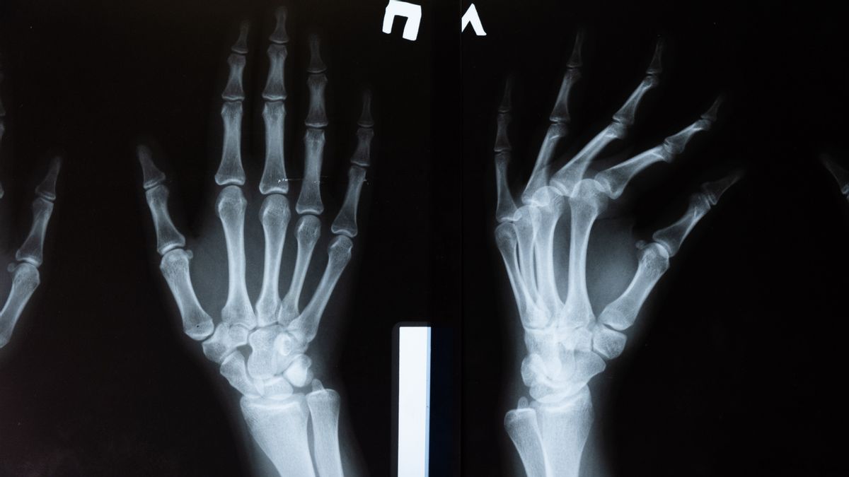 Masuk <i>Silent Disease</i>, Osteoporosis Baru Disadari Jika Ada Patah Tulang