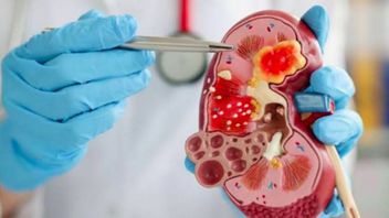 विल्म ट्यूमर क्या है, इसके कारणों और संबंधित लक्षणों के साथ पूरा करना