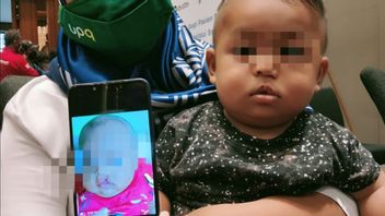 Bhakti Kesehatan, Polda Bali Fasilitasi 12 Anak untuk Operasi Bibir Sumbing 