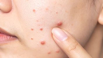 Obat Jerawat Haloskin: Solusi Perawatan Kulit Ampuh dari Halodoc