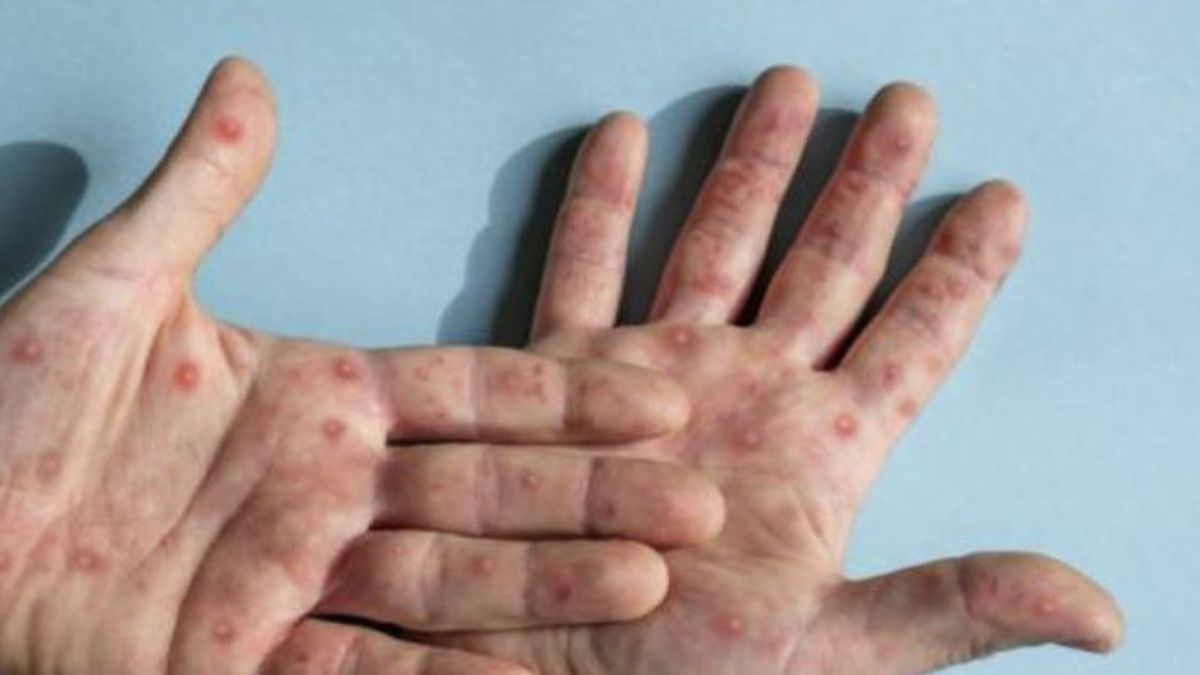 2 Bogor Residents Exposed To Monkeypox