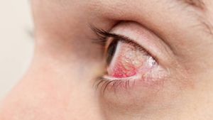Kondisi Mata Uveitis Jadi Salah Satu Penyumbang Besar Kebutaan