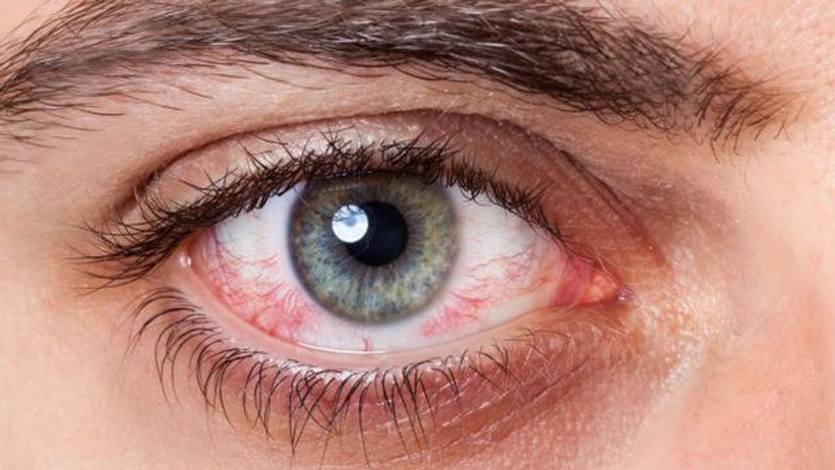 Apa Obat Mata Belekan? Simak Cara Ampuh Mengatasinya di Sini 
