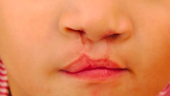 Bibir Sumbing Bisa Dideteksi Sejak Kandungan, Orangtua Perlu Siap Sejak Dini
