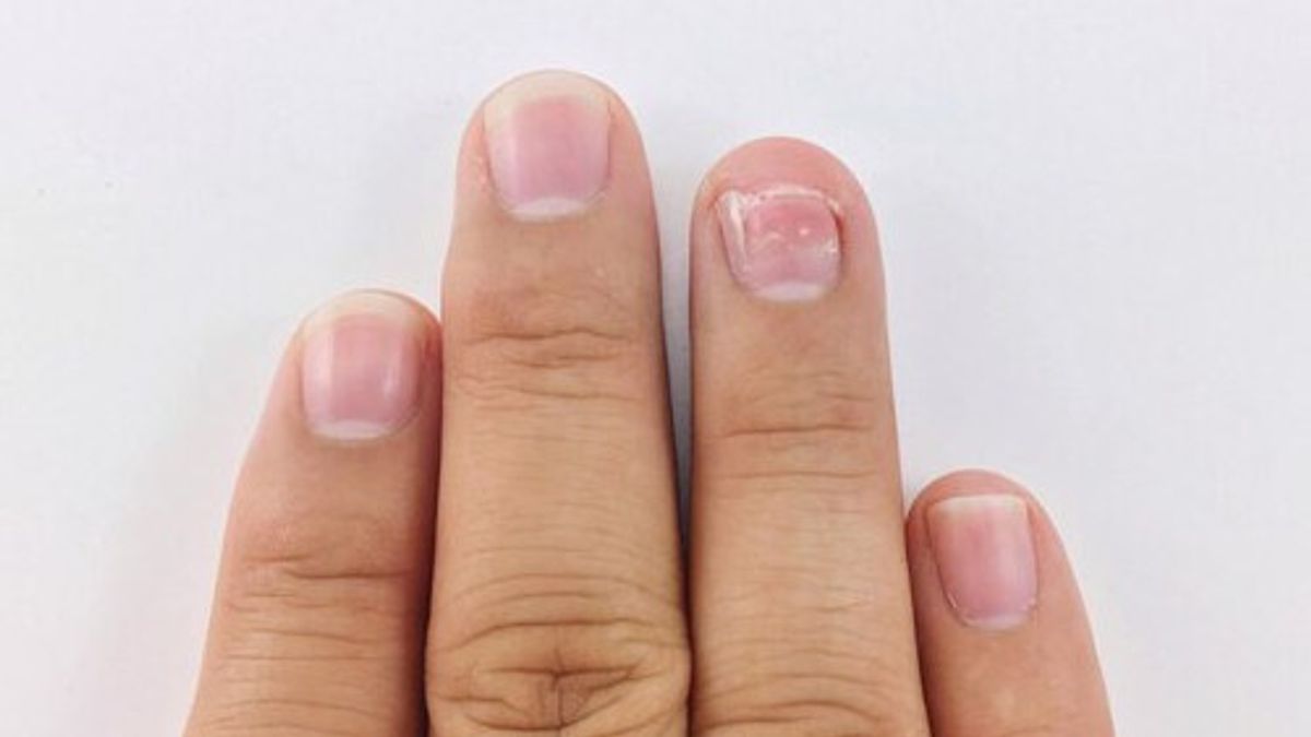 7 Problems For Nails That Can't Be Ignored, Acquires Autoimmune Effects Or Certain Diseases