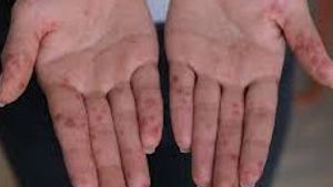 Ciri-Ciri Flu Singapura pada Orang Dewasa yang Perlu Diwaspadai