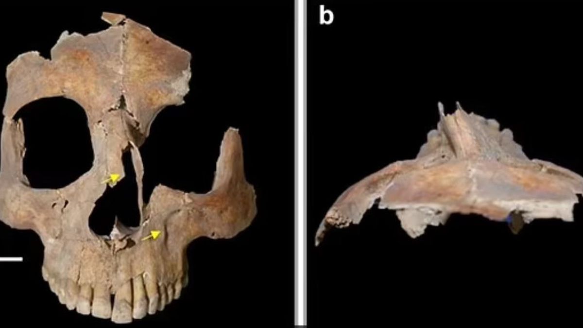 新しい証拠が見つかりました、脳外科手術は3,500年前にイスラエルで行われました