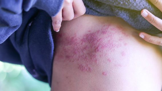 水痘の原因ウイルスは体から消えず、水痘に発展する可能性があります