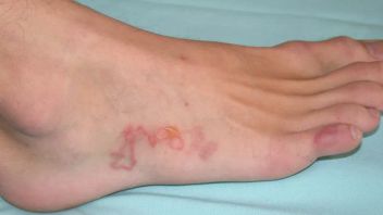 يمكن أن يسبب الحكة! هذه هي الطريقة لإخراج دودة الرمل من الجلد بشكل طبيعي