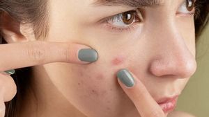 Waspada Bahaya Mikroplastik untuk Kesehatan Kulit, Dapat Picu Jerawat hingga Alergi!