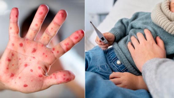 Les cas de HMFD chez les enfants continuent d’augmenter, la vaccination peut être une solution?