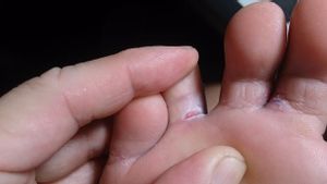Cara Mengobati Kutu Air di Sela Jari Kaki